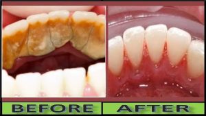 Preventative Dentistry Schofields